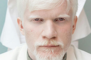 Día Internacional de Sensibilización sobre el Albinismo